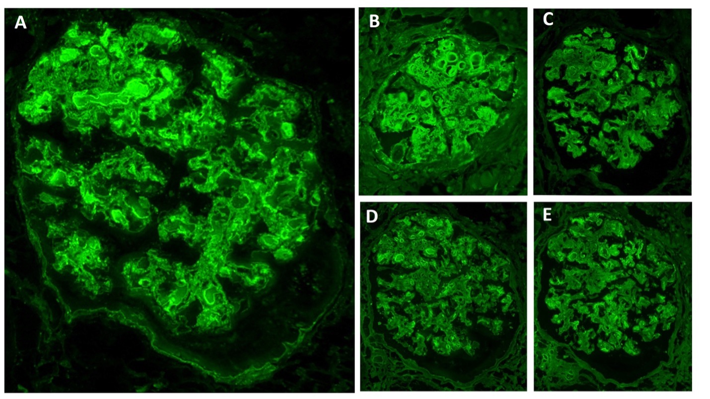 <p>Immunofluorescence in Mixed Cryoglobulinemic Glomerulonephritis