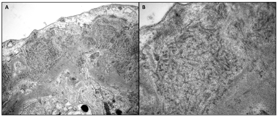 <p>Electron Microscopy Demonstrating Microtubular Deposits within the Glomerular Basement Membranes