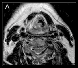 <p>MRI Demonstrating Hypopharyngeal Cancer