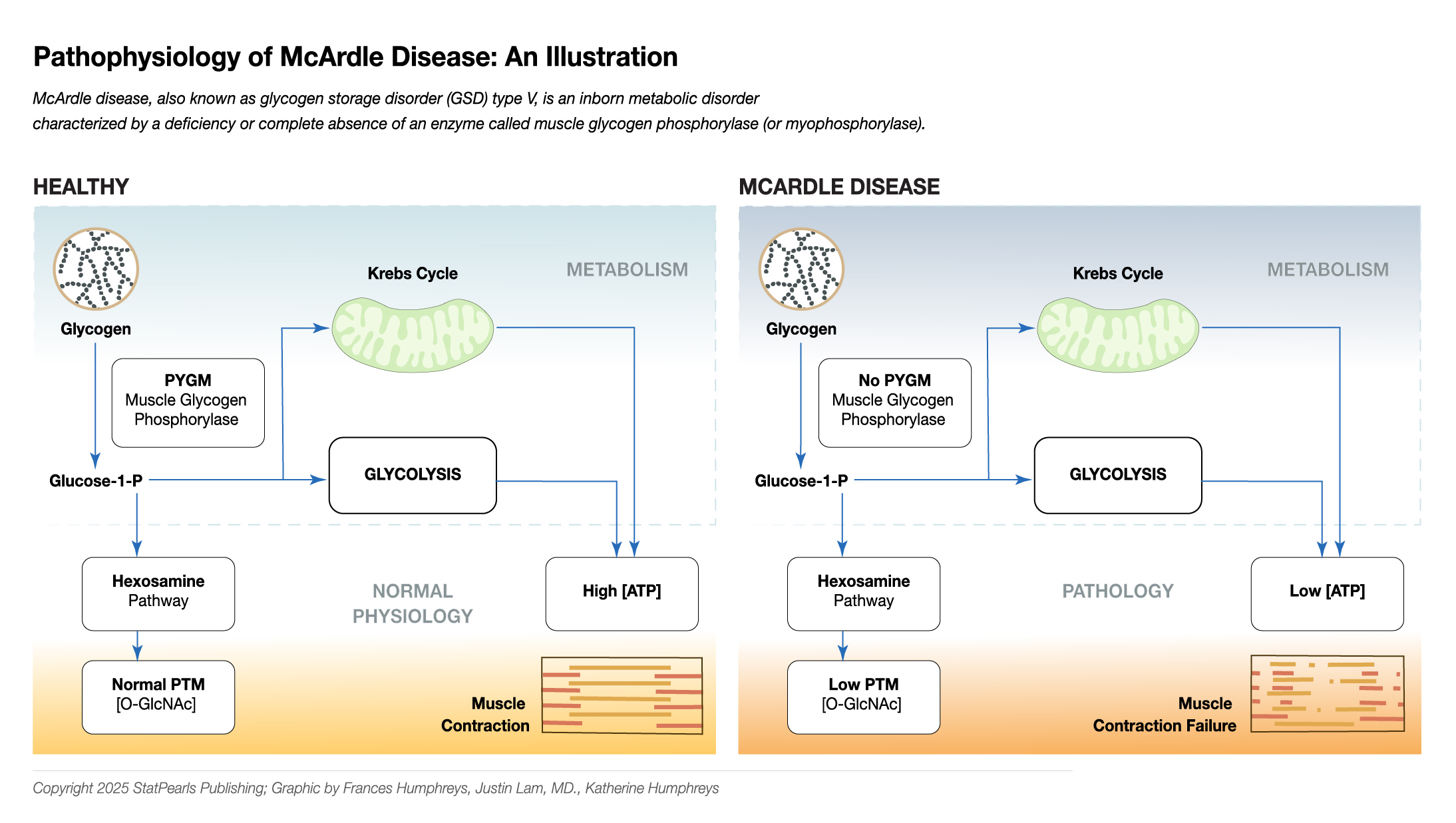 <p>Pathophysiology of McArdle Disease.</p>