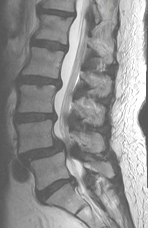 <p>Degenerative Spondylolisthesis. L4-5 degenerative spondylolisthesis causing severe stenosis.</p>
