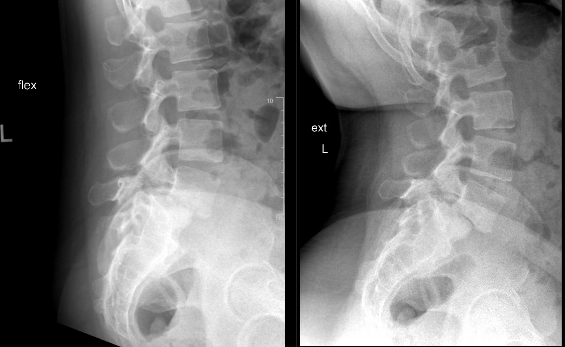 <p>Isthmic Spondylolisthesis. L5-S1 isthmic spondylolisthesis with instability on flexion-extension views.</p>