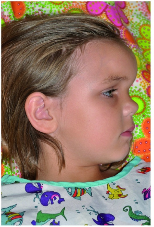 <p>Pott Puffy Tumor in a Girl Aged 8 on Day 12 of Infection