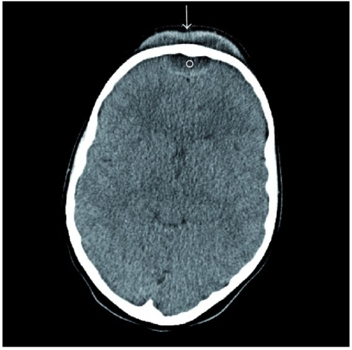 <p>Axial Contrast-Enhanced CT of Pott Puffy Tumor in a Girl Aged 8