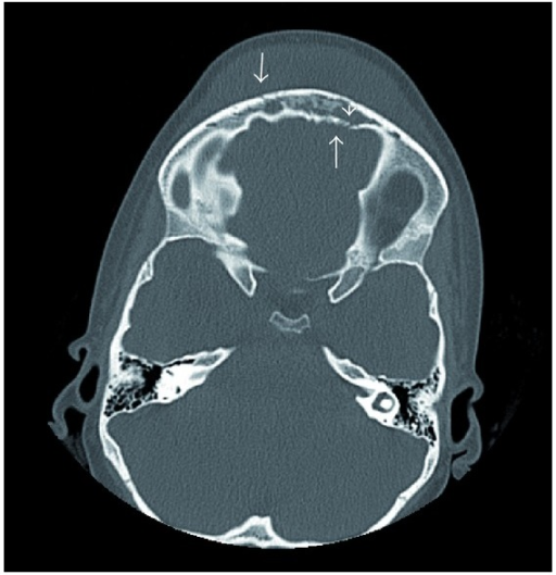 <p>Axial Non-Contrast CT of Pott Puffy Tumor in a Girl Aged 8