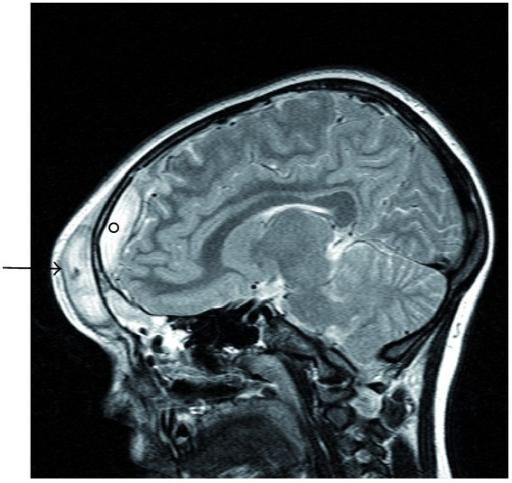 <p>Sagittal MRI of Pott Puffy Tumor in a Girl Aged 8