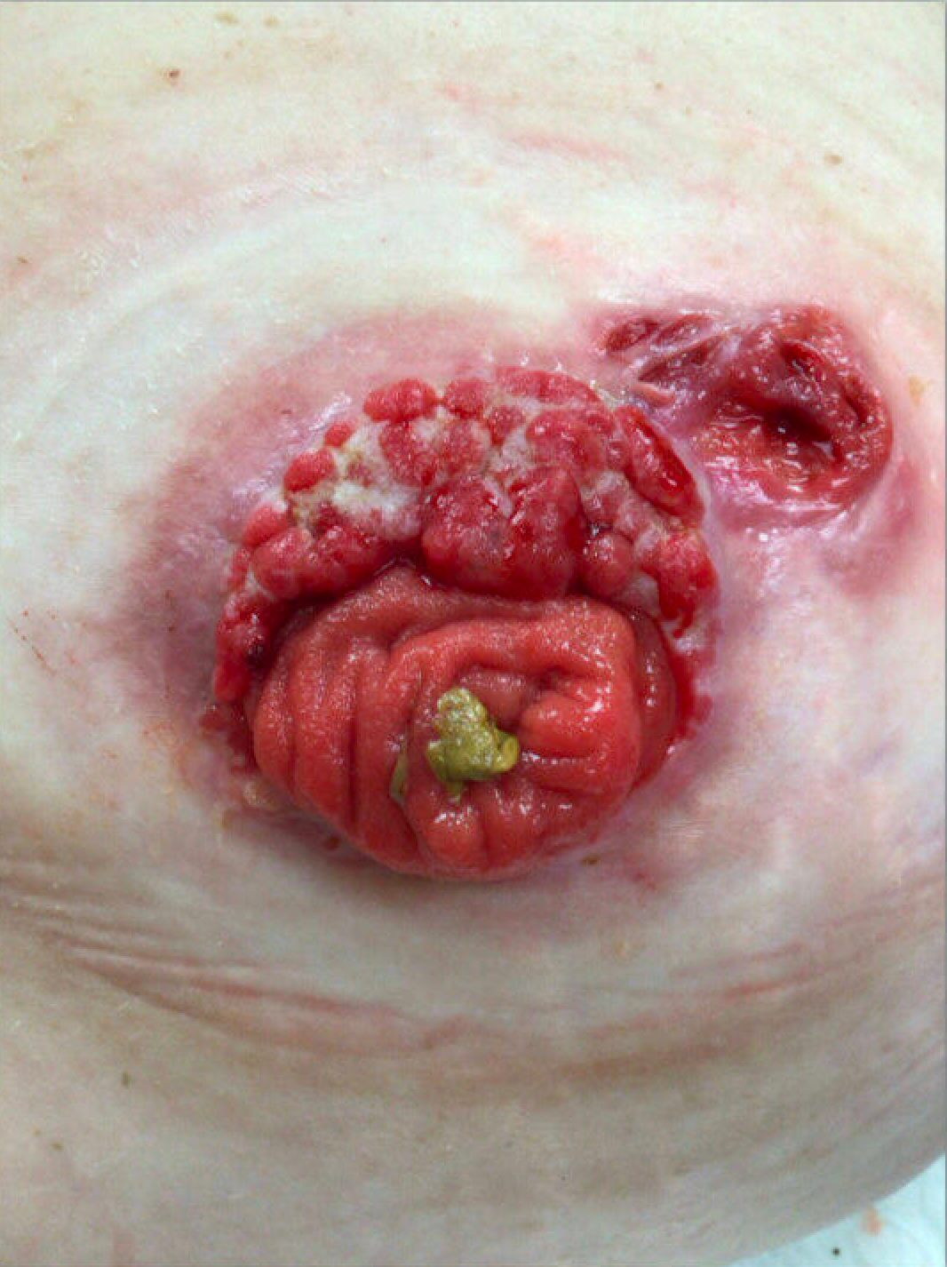 <p>Cutaneous Crohn Disease