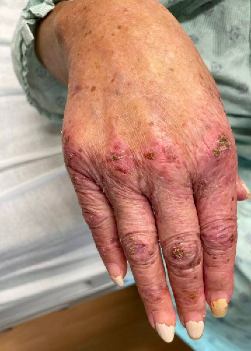 <p>Vitamin A Deficiency