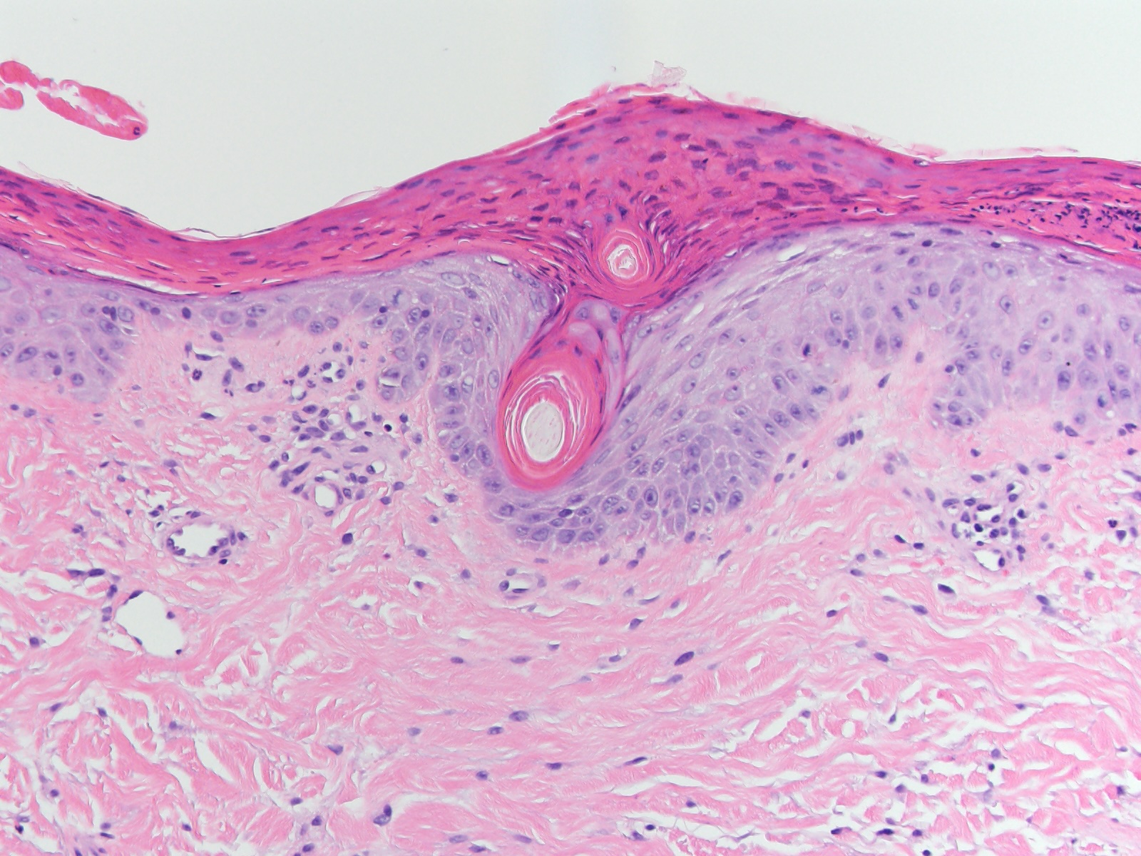 <p>Histopathology of Vitamin A Deficiency
