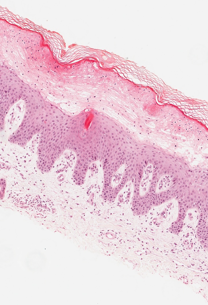 <p>Histopathology of Pellagra