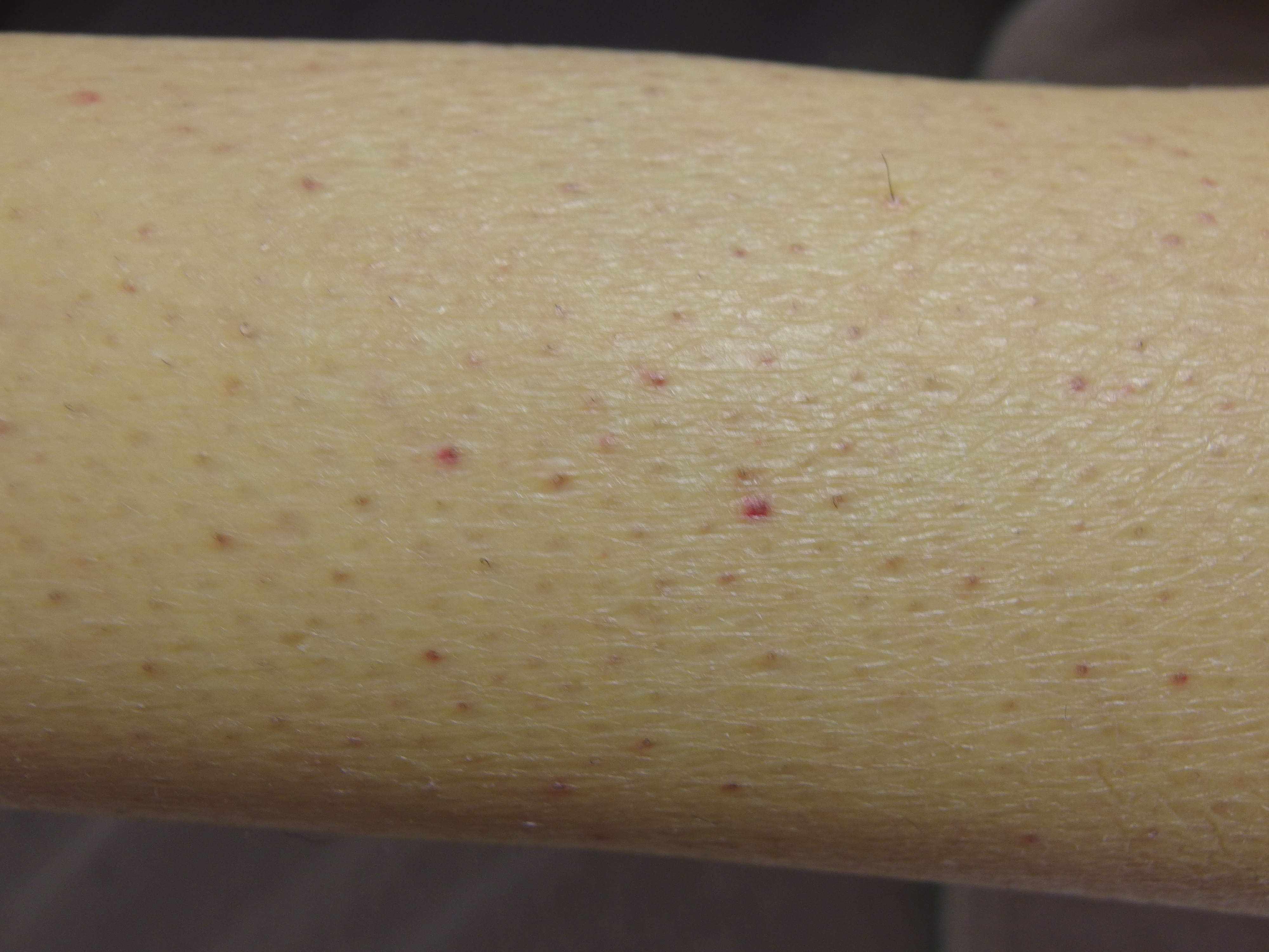 <p>Scurvy Clinical 1