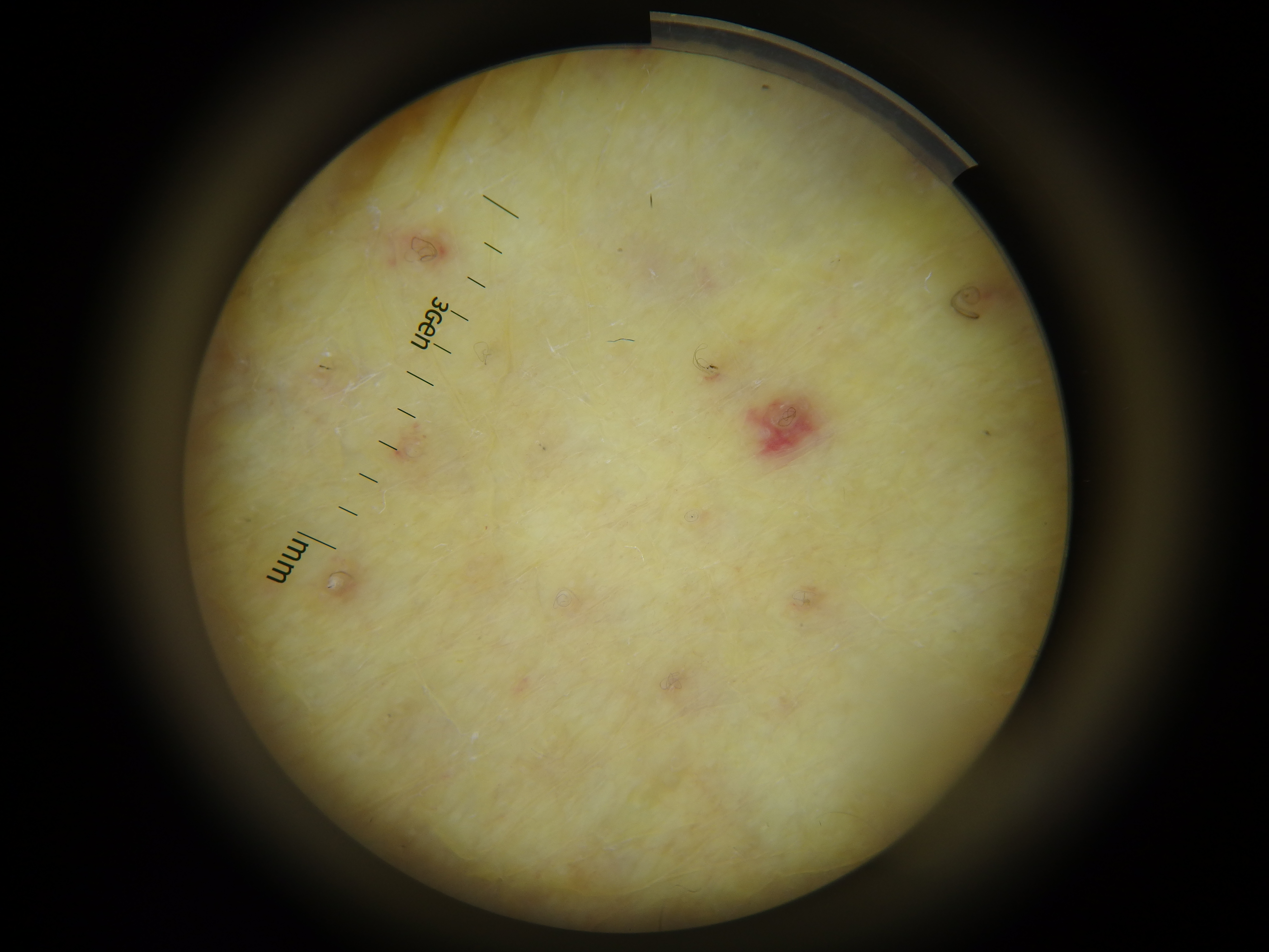 <p>Dermoscopy of Scurvy