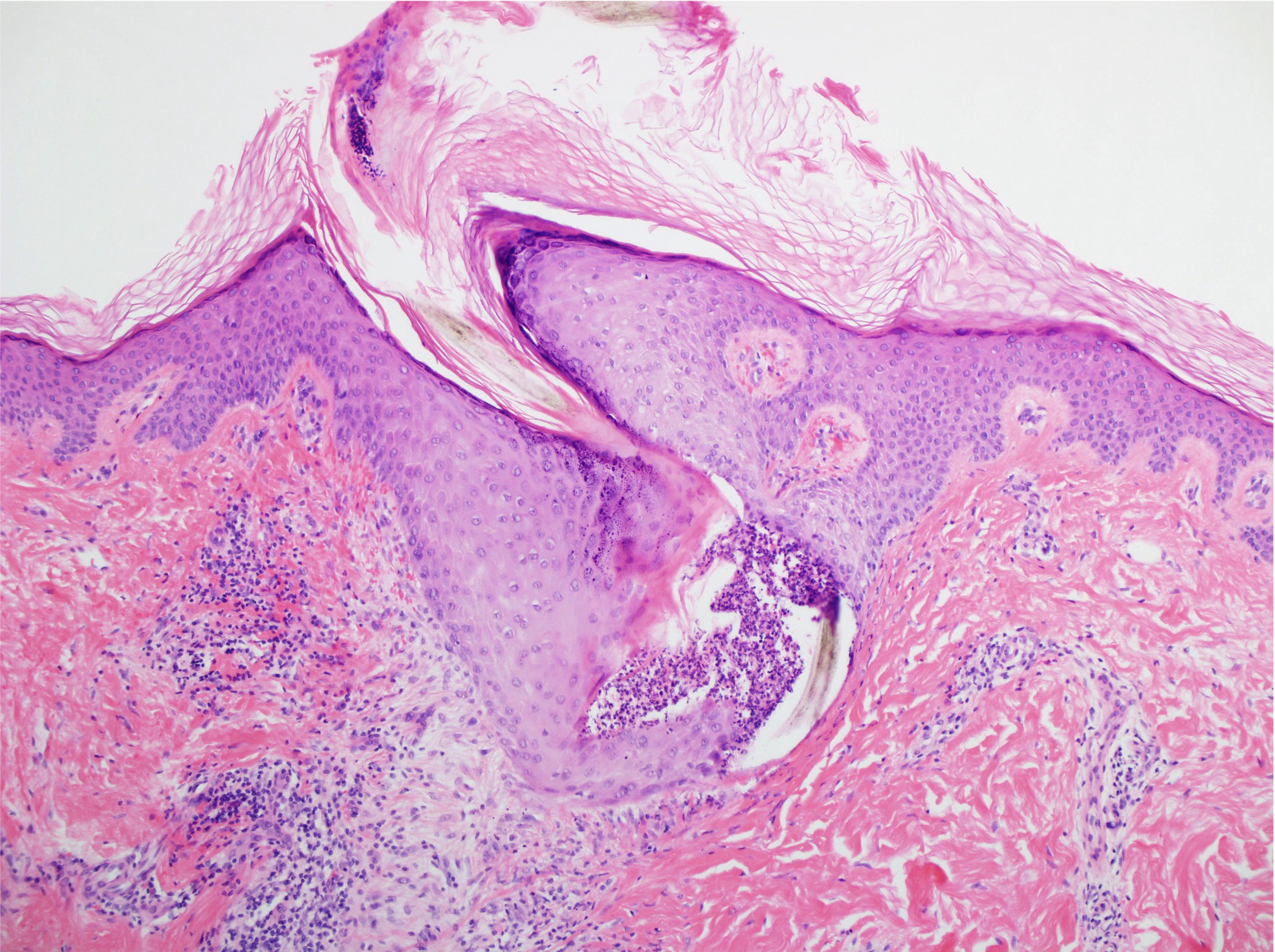 <p>Histopathology of Scurvy