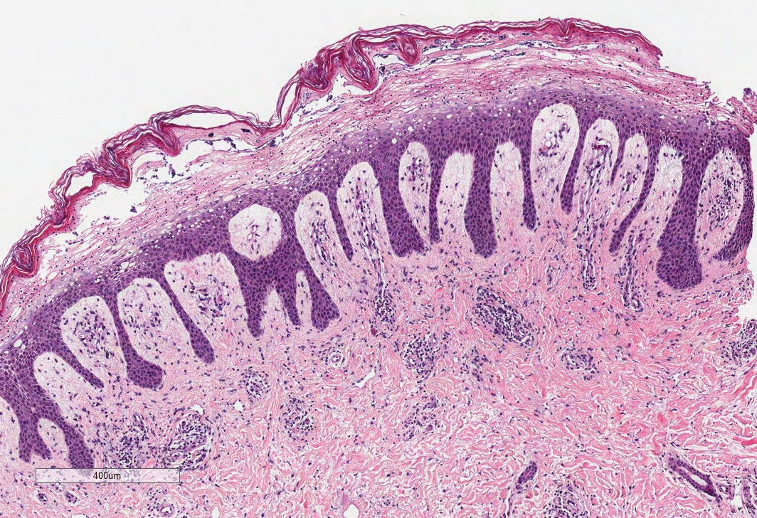 <p>Histopathology of Acrodermatitis Enteropathica