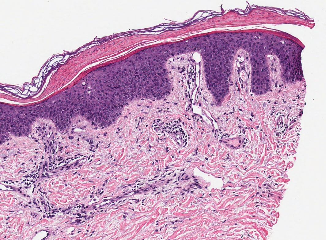 <p>Histopathology of Glucagonoma