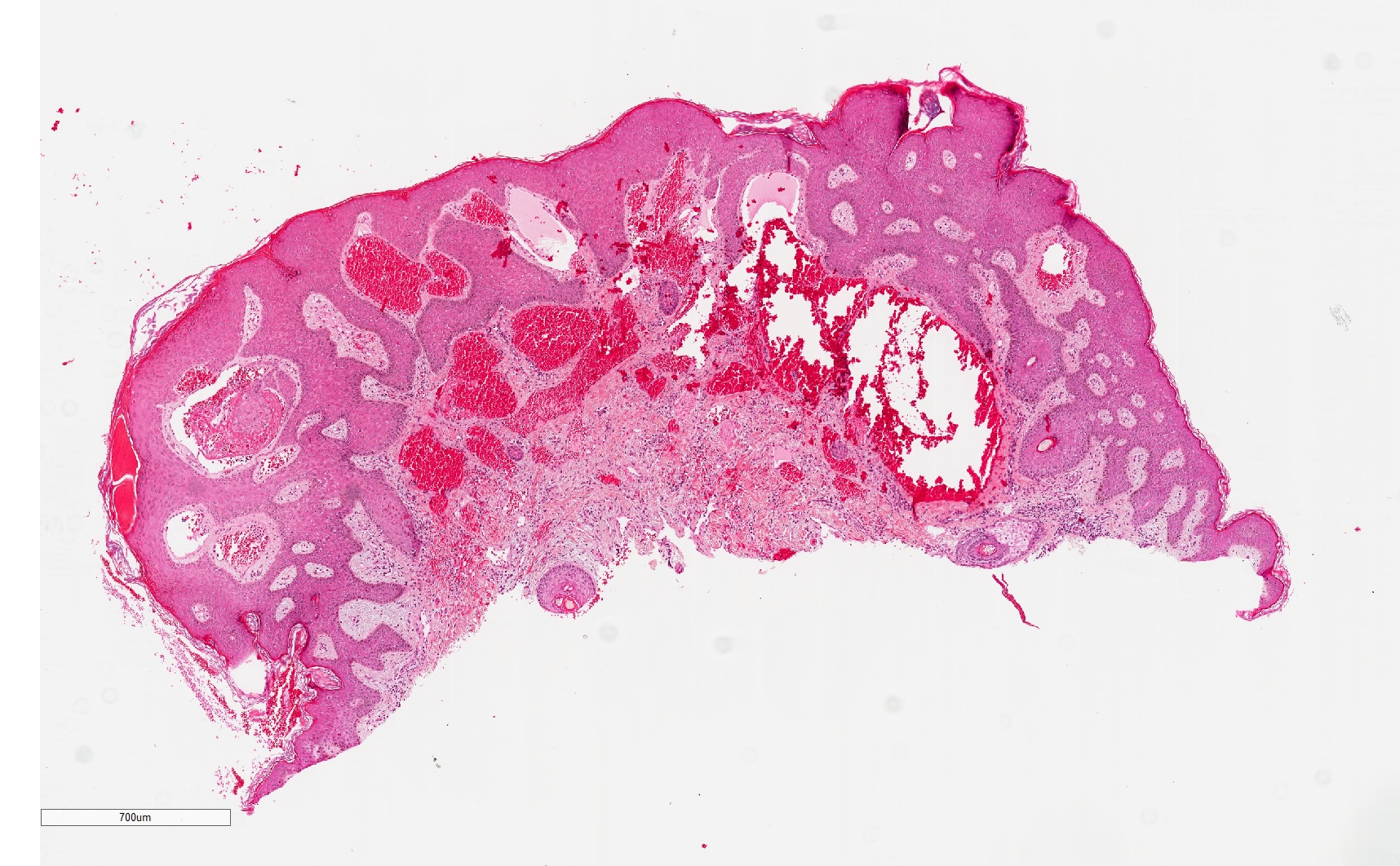 <p>Histopathology of Angiokeratoma