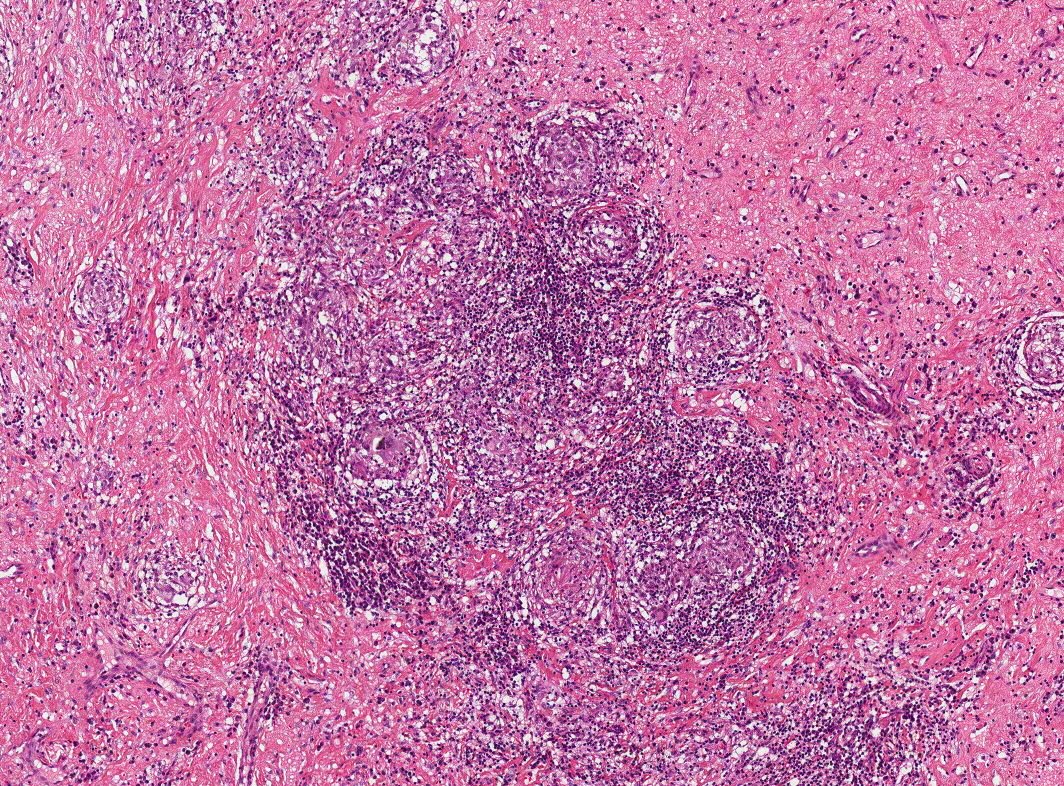 <p>Histopathology of Cutaneous Crohn Disease
