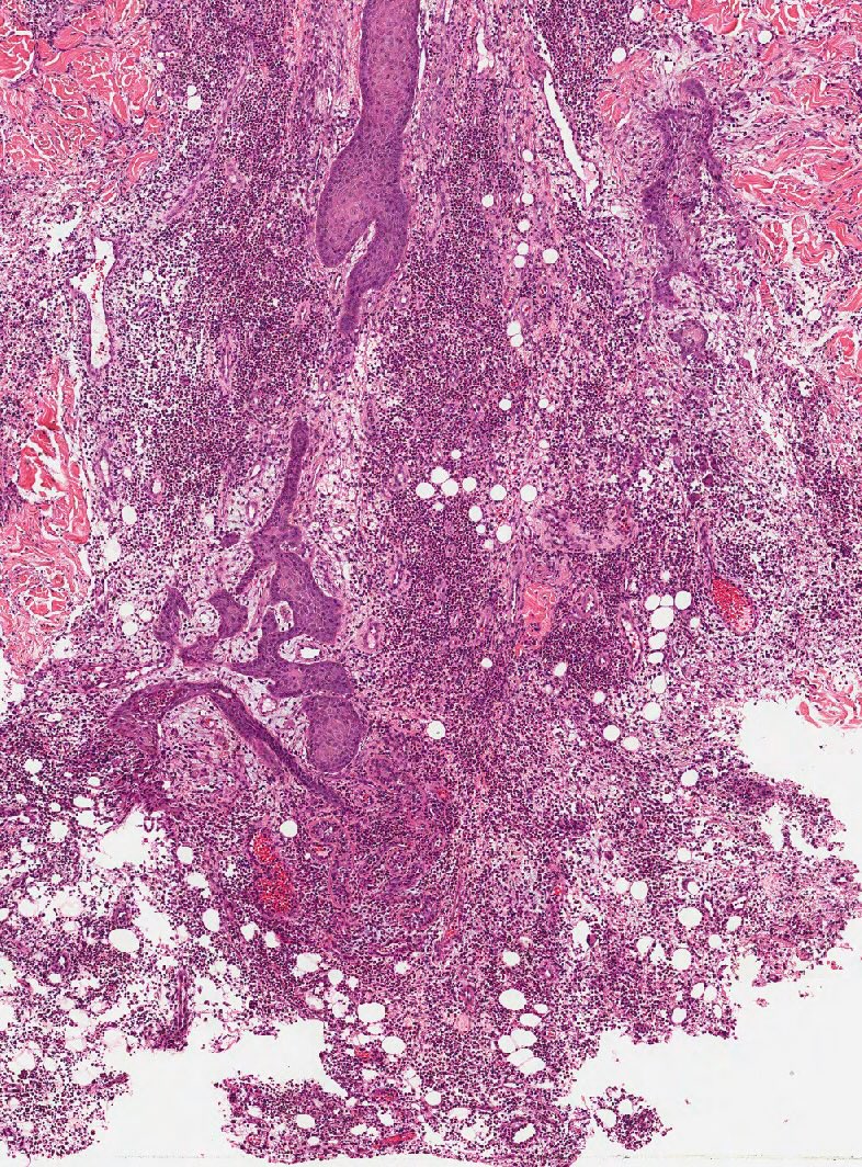 <p>Histopathology of Pyoderma Gangrenosum