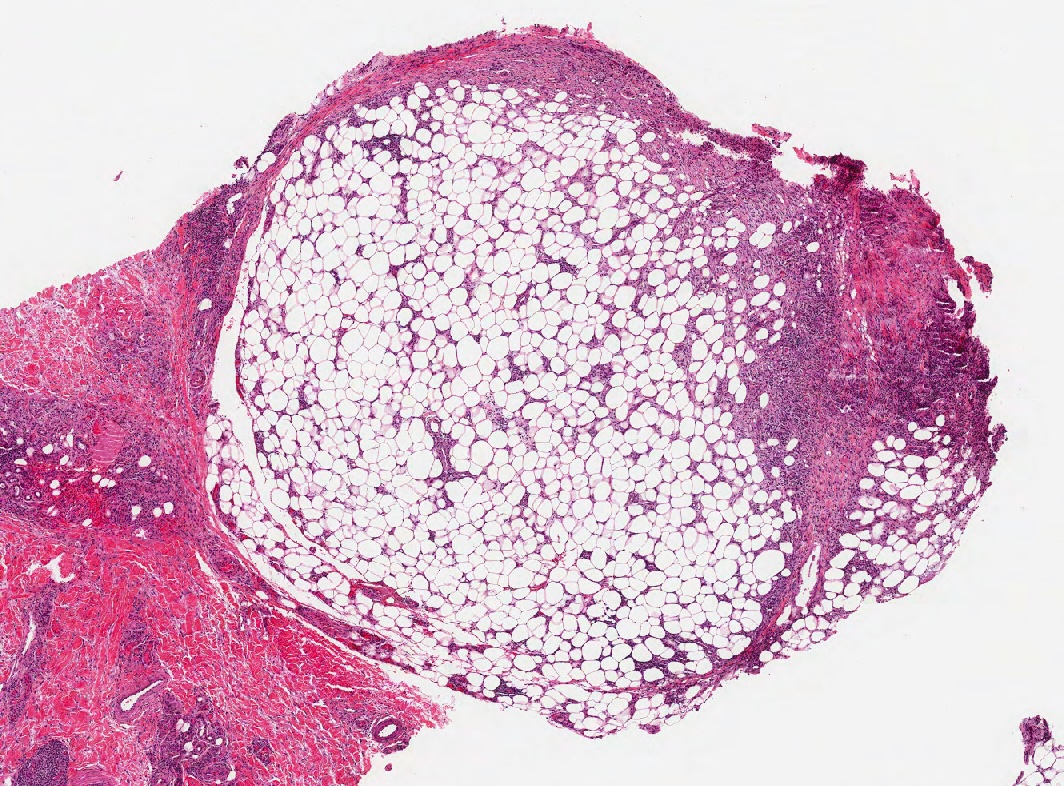 <p>Histopathology of Erythema Nodosum