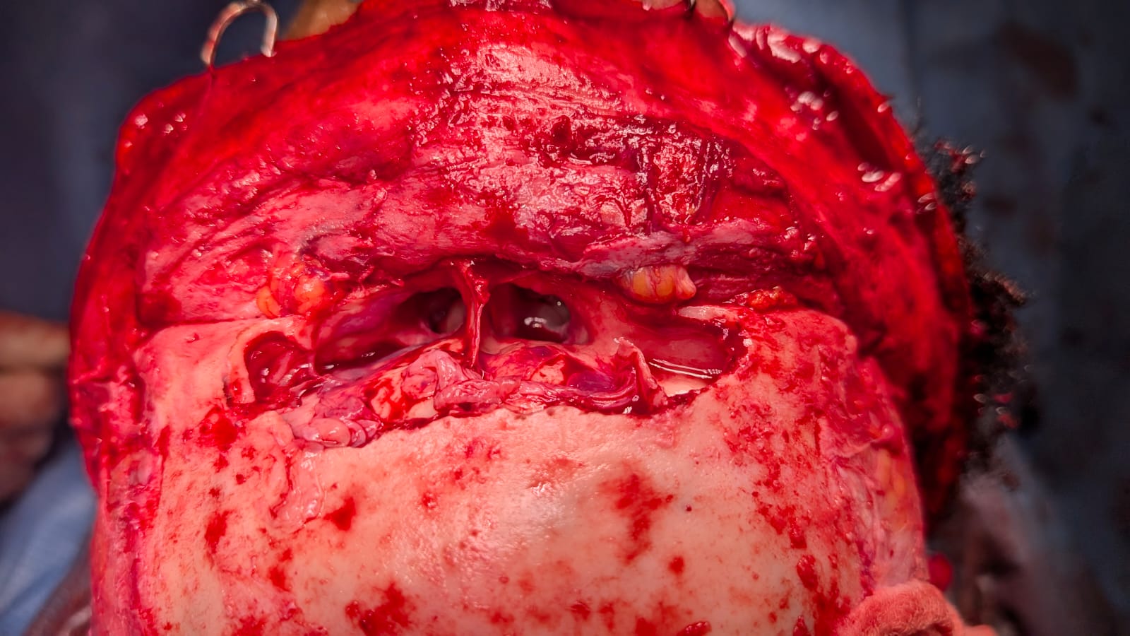 <p>Coronal Approach to the Frontal Sinus