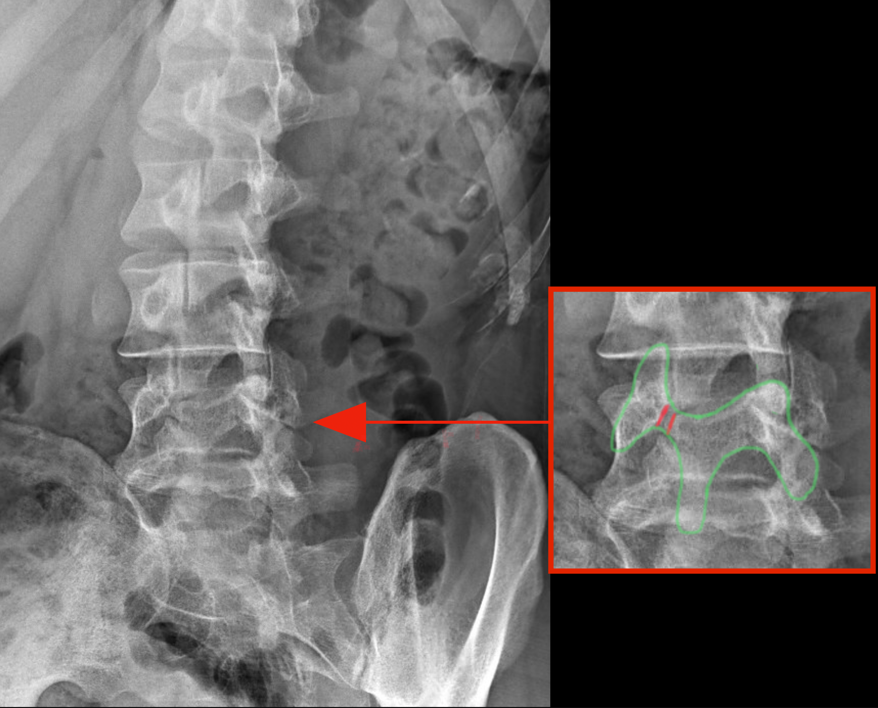 <p>"Scotty Dog" Finding. X-ray image demonstrating the "Scotty dog" findings associated with isthmic spondylolisthesis.</p>