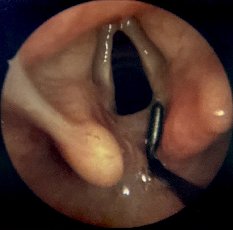 <p>Diagnostic Laryngoscopy of a Type I Laryngeal Cleft. The cleft is palpated with a probe to examine its extent.</p>