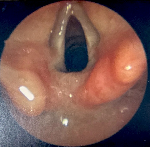 <p>Diagnostic Laryngoscopy of a Type I Laryngeal Cleft Before Palpation