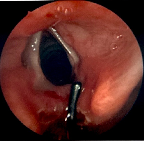 <p>Type I Laryngeal Cleft Undergoing Repair. Note the opposing surfaces denuded of mucosa.</p>