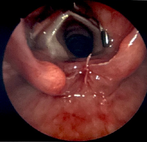 <p>Type I Laryngeal Cleft After Endoscopic Repair With Sutures