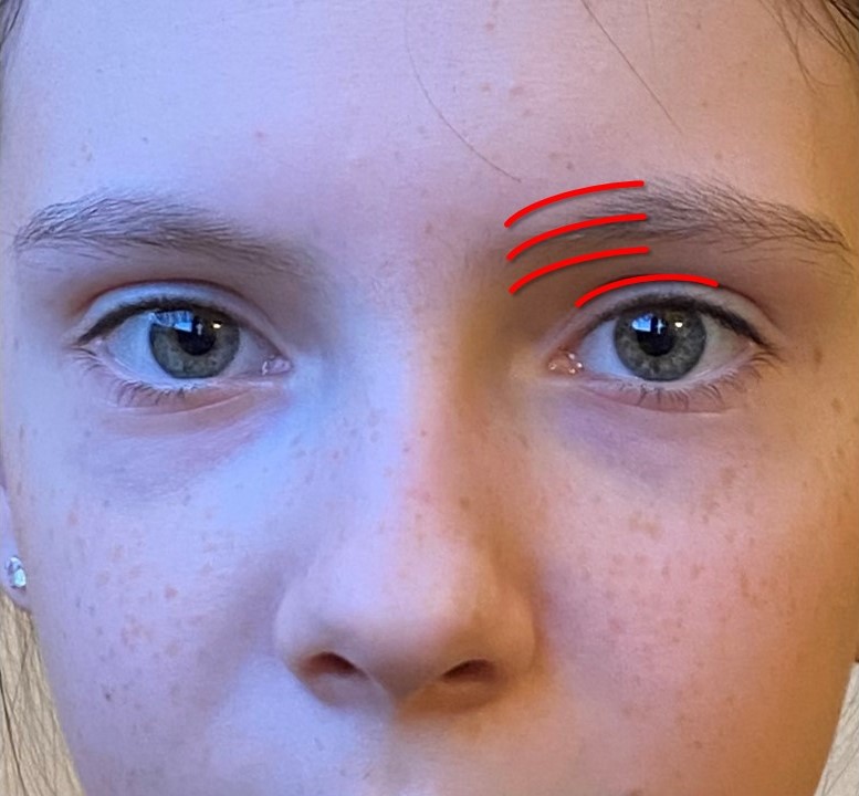 <p>Approaches For Frontal Sinus Trephination