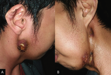 <p>Scrofuloderma Involving Bilateral Cervical Lymph Nodes.&nbsp;</p>