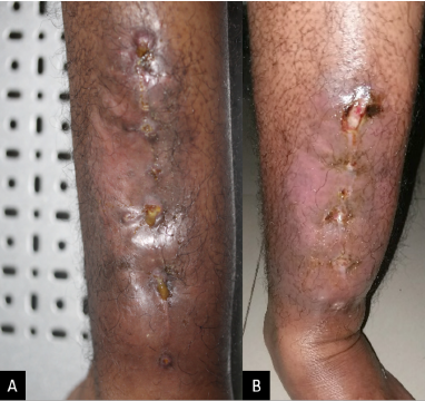 <p>Tuberculous Chancre