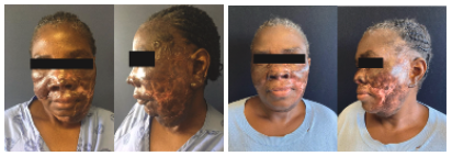<p>Lupus Vulgaris, Pre- and Posttreatment