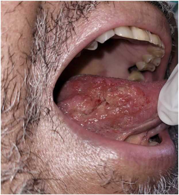 <p>Orificial Tuberculosis. An ulcer is seen on the right lateral margin of the tongue.</p>