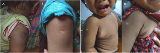 <p>Bacillus Calmette-Gu&eacute;rin Scar and Lymph Nodal Abscess and Progression