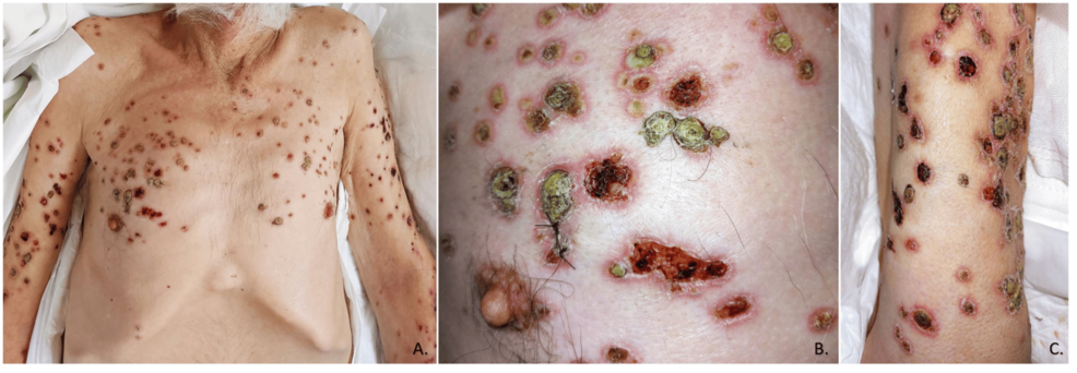 <p>Miliary Cutaneous Tuberculosis