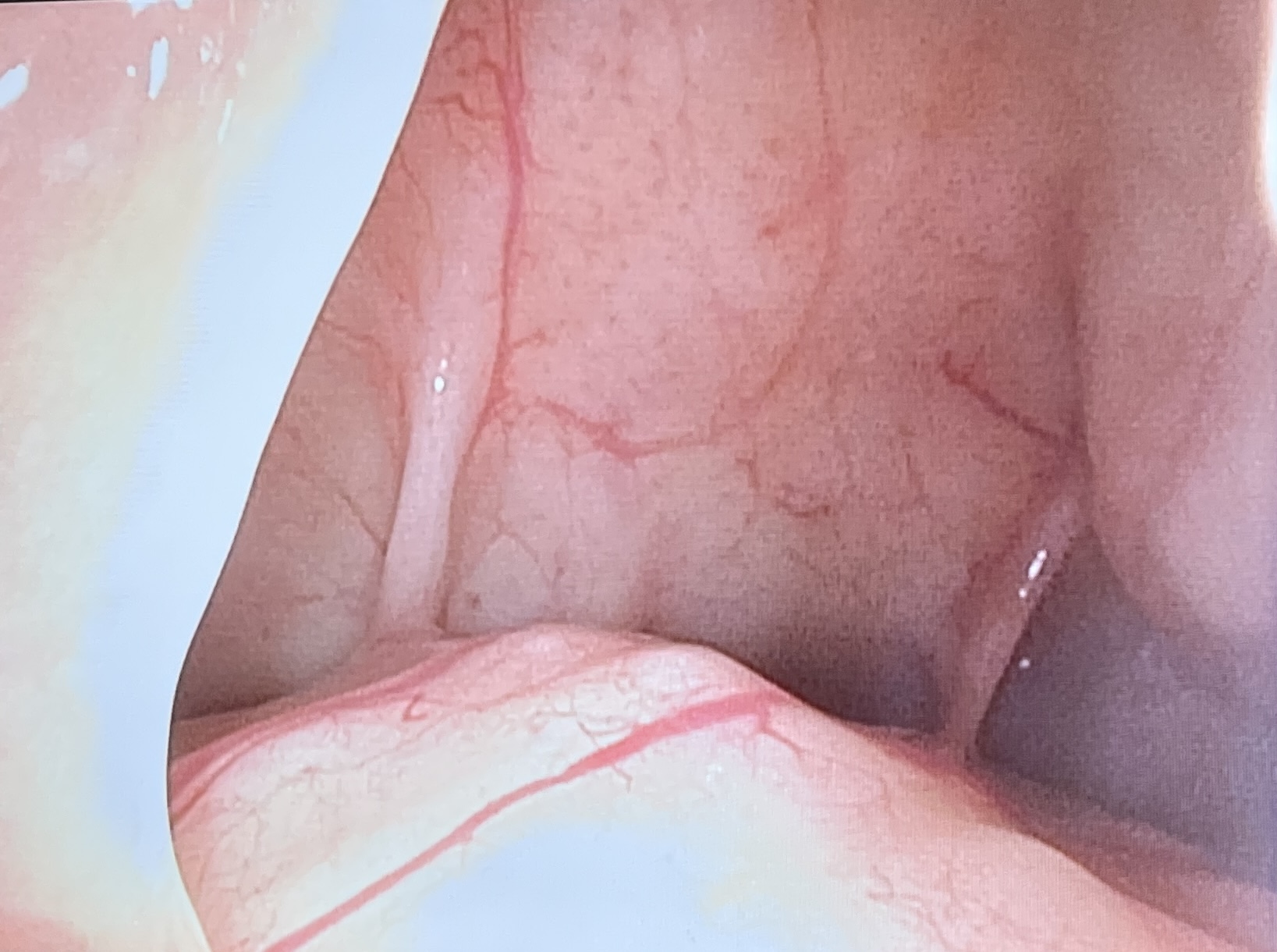 <p>Endoscopic View of the Frontal Sinus.</p>