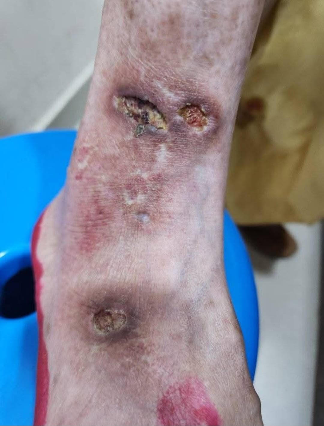 <p>Papulonecrotic Tuberculid. The lesions appear over the ankle and tibia in this patient from Nepal.</p>