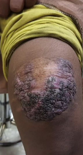 <p>Tuberculosis Verrucosa Cutis. Inoculation of the skin of the knee in person from Nepal.</p>