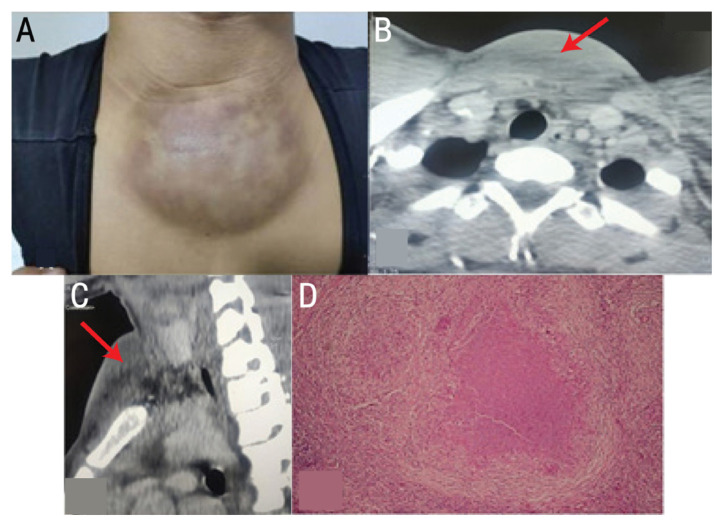 <p>Tuberculous Abscess