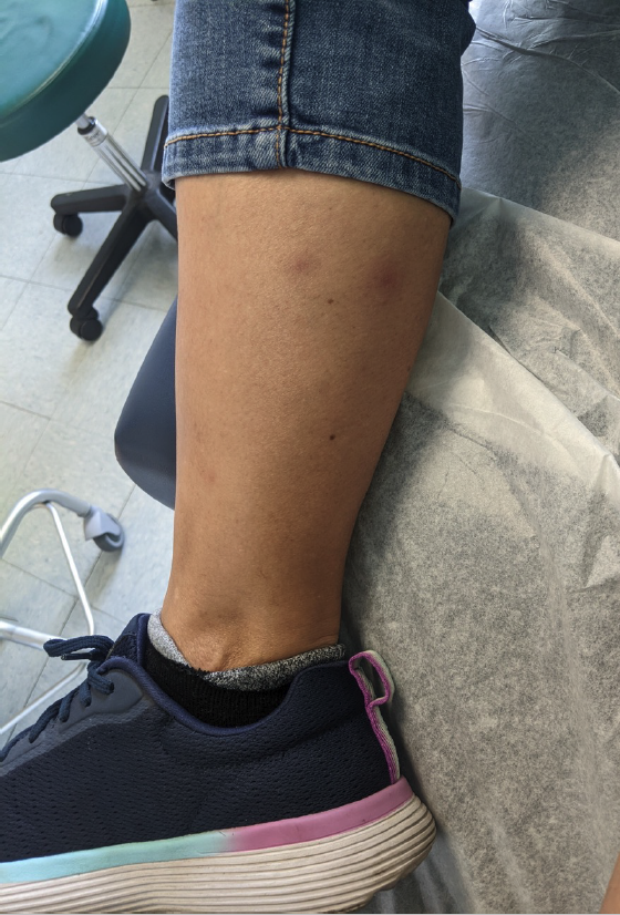 <p>Erythema Induratum of Bazin in a 48-Year-Old Female