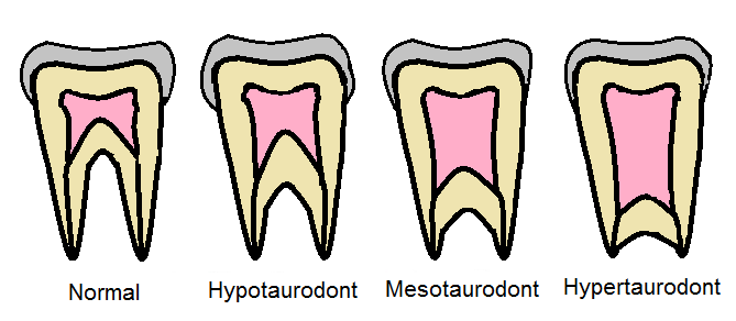 <p>Dental Taurodontism. This image compares the different forms of taurodontism to the normal tooth.</p>