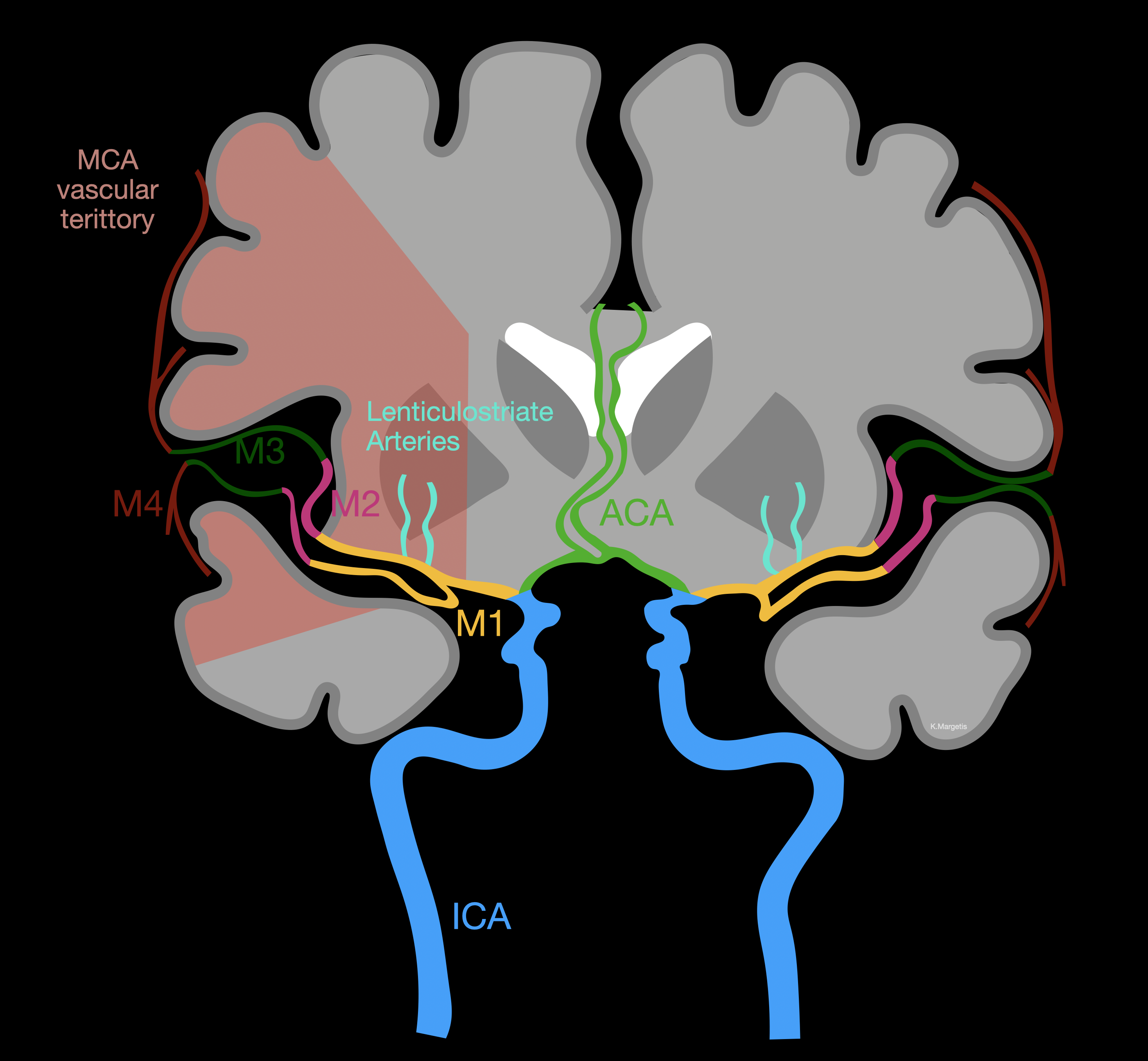 <p>Course of the Middle Cerebral Artery