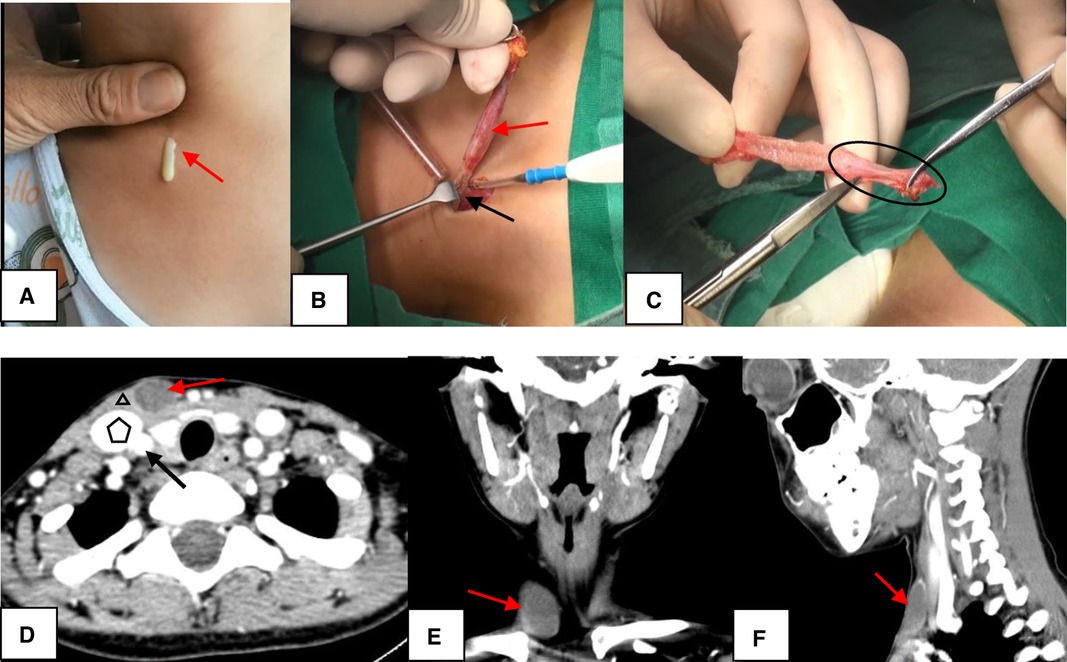 <p>Second Branchial&nbsp;Cleft Anomaly
