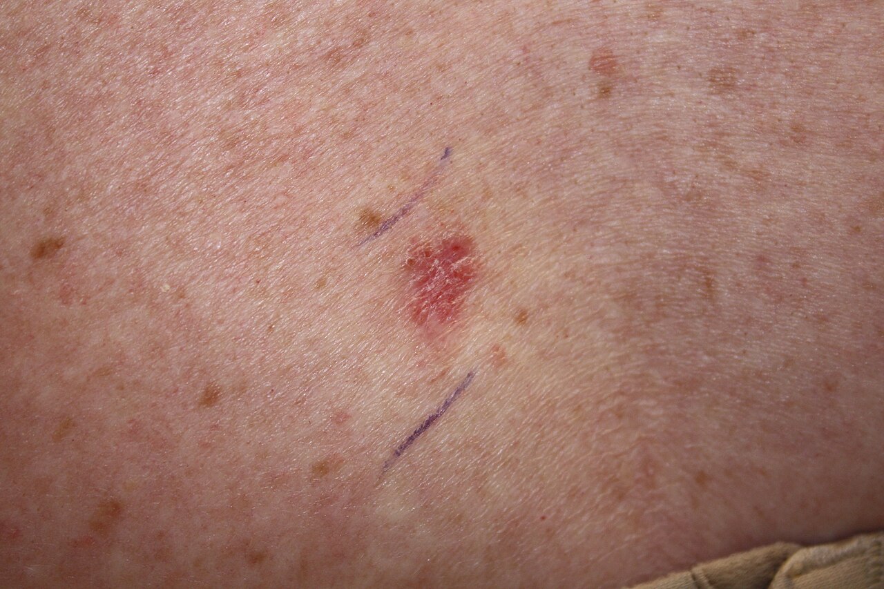 <p>Basal Cell Carcinoma Presenting as Pink Papules on a Patient's Skin.</p>