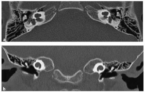 <p>Mondini Deformity. Mondini deformity CT, axial. B: Mondini deformity CT, coronal</p>