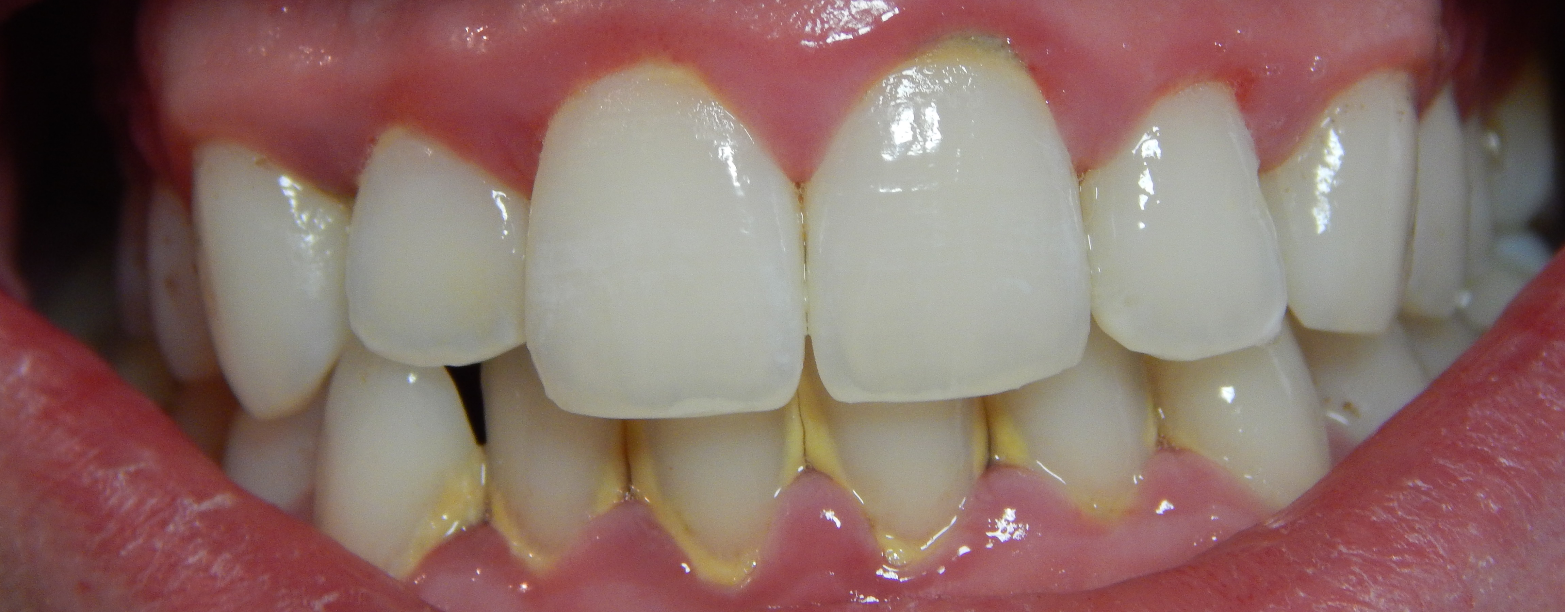 <p>Gingivitis with Calculus Buildup