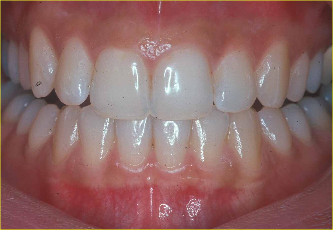 <p>Healthy Periodontium.</p>