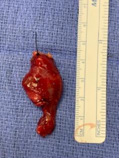 <p>Excision of a Right Second Branchial Cleft Cyst With Tract.</p>