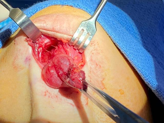 <p>Right Second Branchial Cleft Cyst.</p>
